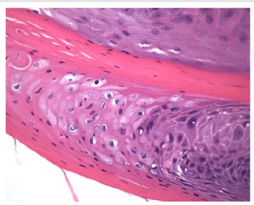 Lupine Publishers: Lupine Publishers | Oral Squamous Papilloma on the Tongue of a 12-Year Old ...