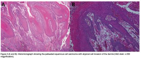 Cornu cutaneum in the maxillofacial region - A case report