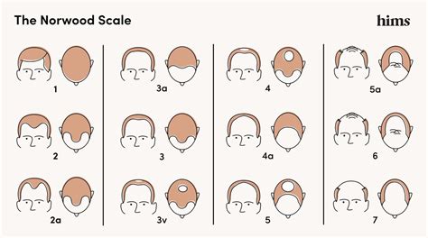 The Norwood Scale: Hair Loss Stages, & Treatments | hims