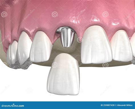 Custom Abutment, Dental Implant and Ceramic Crown. Medically Accurate ...