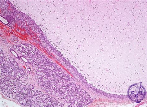 7.Oral, Salivary gland (2) Mucocele|Pathology Core Pictures