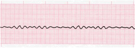 Ventricular Fibrillation ECG Interpretation #315