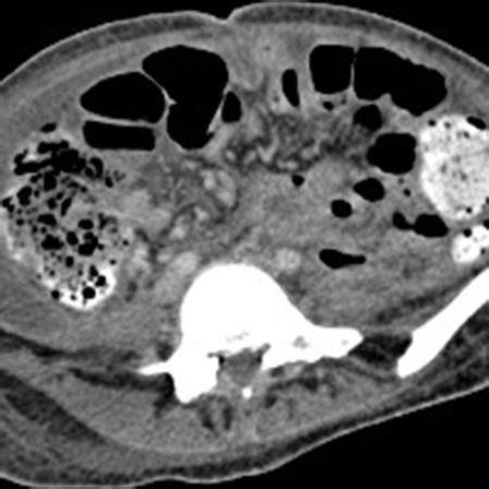 Axial CT scan after embolization and bilateral nephrectomy. | Download ...