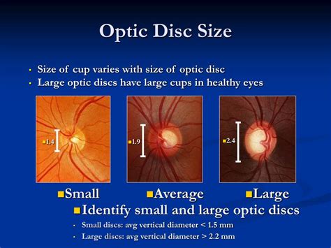 PPT - Fine Tuning Glaucoma Diagnosis and Management in Haiti PowerPoint Presentation - ID:6665556