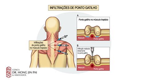 Dor no Trapézio - quando se preocupar? - Clínica Dr. Hong Jin Pai - Dor, Fisiatria e Acupuntura ...