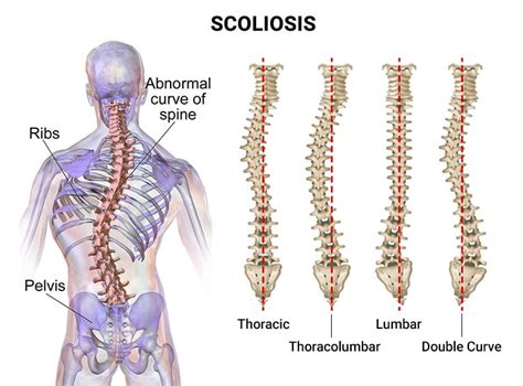 Scoliosis Doctors in NJ & NYC | Scoliosis Treatment Specialists