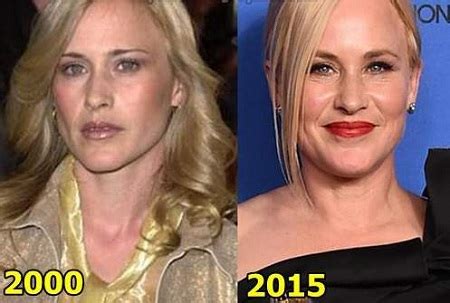 Patricia Arquette Plastic Surgery - Her Views on the Topic | Glamour Fame