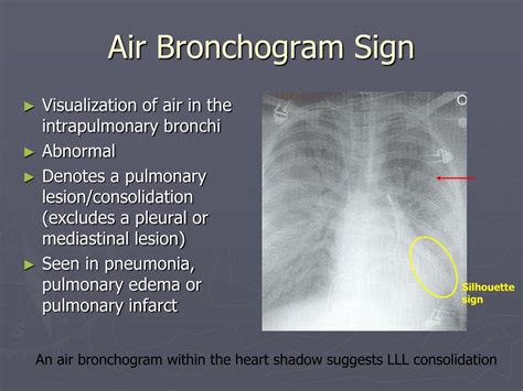 PPT - Interpretation of Chest Radiographs PowerPoint Presentation, free download - ID:458485