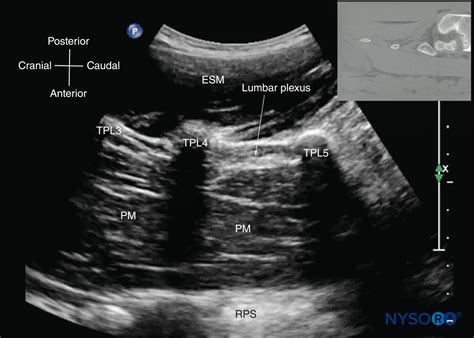 Ultrasound Spine Anatomy