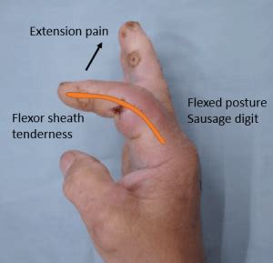 Kanavel Sign for Pyogenic Flexor Tenosynovitis | Epomedicine