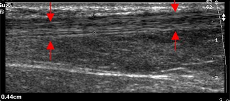 emDOCs.net – Emergency Medicine EducationUltrasound for Achilles Tendon ...