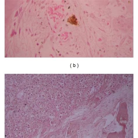 (a) Osteoblastic variant of osteogenic sarcoma of case 1 showing ...