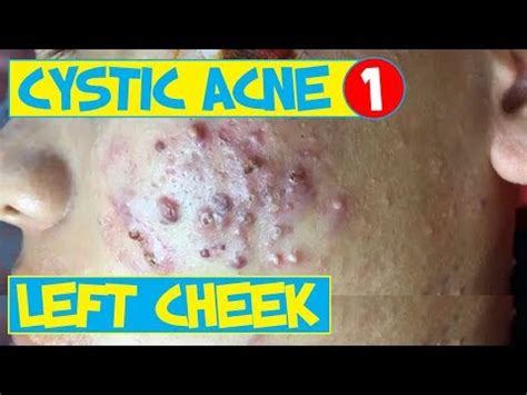 Inflamed Cystic Acne Removal | Part 1: On The Left Cheek ...