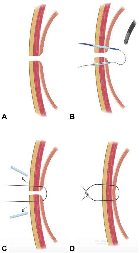 Closure of refractory gastrocutaneous fistula with endoscopically guided percutaneous suturing ...