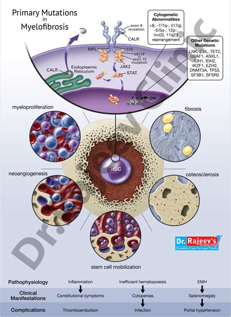 Homeopathic Treatment for Myelofibrosis, Treatment of Myelofibrosis