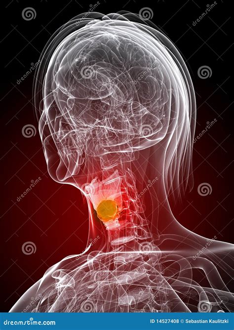 Larynx Cancer Royalty Free Stock Photos - Image: 14527408