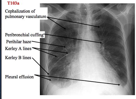 cephalization of the pulmonary vasculature - Google Search | PA School | Pinterest | Pa school ...