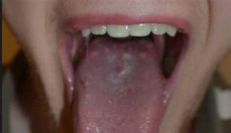 Main Causes of Large Bumps on Back of the Tongue | IYTmed.com