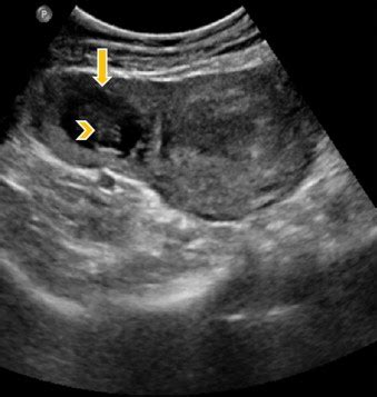 Ultrasound of the pelvis at the 7th week of pregnancy shows bicornuate... | Download Scientific ...