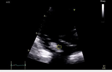 An image of the tricuspid valve of the first transthoracic... | Download Scientific Diagram