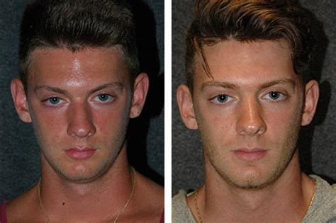 Male Rhinoplasty Photos | Male Nose Job Patient Photos