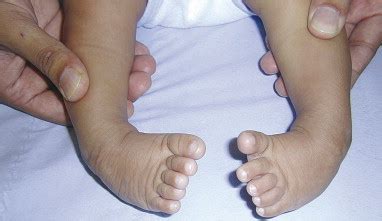 Congenital talipes equinovarus (clubfoot) - Surgery - Oxford International Edition