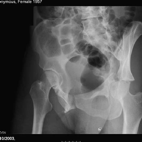 Pre-operative AP pelvis plain radiograph. | Download Scientific Diagram