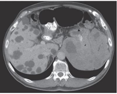 80 Gastrointestinal Stromal Tumor | Radiology Key