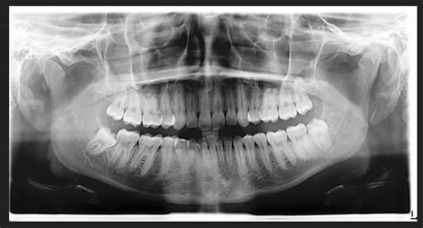 Why is a Panorex x-ray needed before wisdom teeth extractions? | Why is ...