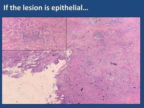 07 histology, cytology and biomarkers in pleural diseases | PPT