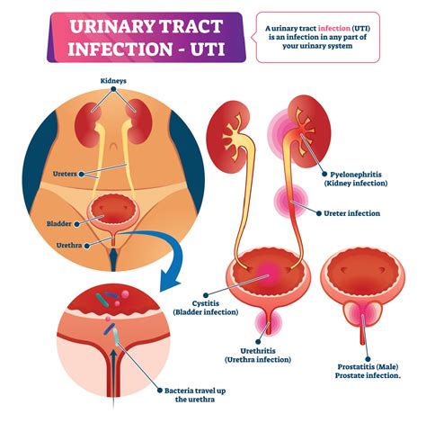 What Happens When You Ignore a UTI? - Z Urology