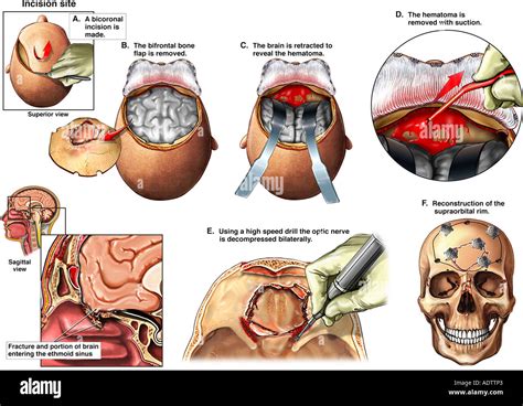 Brain Surgery - Craniotomy Procedure to Remove a Hematoma Stock Photo ...