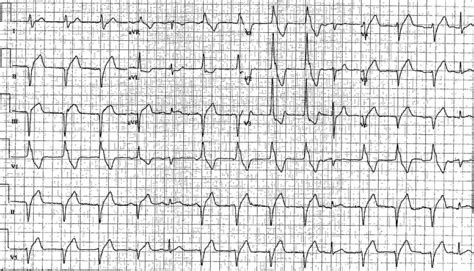 Accelerated idioventricular rhythm - wikidoc