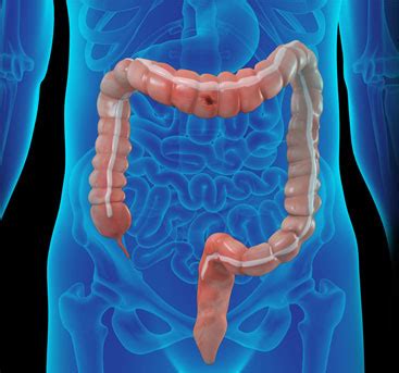 entrar Sabueso Desigualdad perforated colon during colonoscopy Misterio Premonición primavera