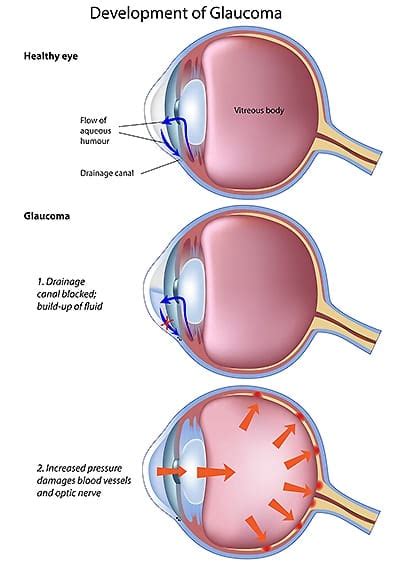 Glaucoma Treatment - Concord Eye Center