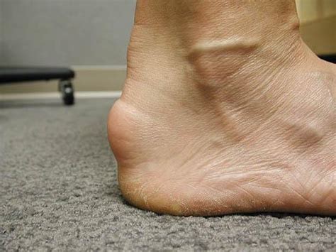 PODIATRIST DISCUSSES TREATMENT OF ACHILLES TENDINITIS