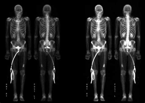 Exported BENIGN BONE TUMOR ON BONE SCINTIGRAPHY