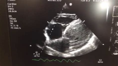 Left ventricular thrombus - YouTube