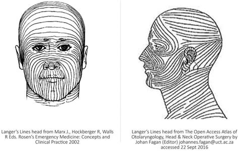 Biodynamic Excisional Skin Tension (BEST) Lines: Revisiting Langer’s ...