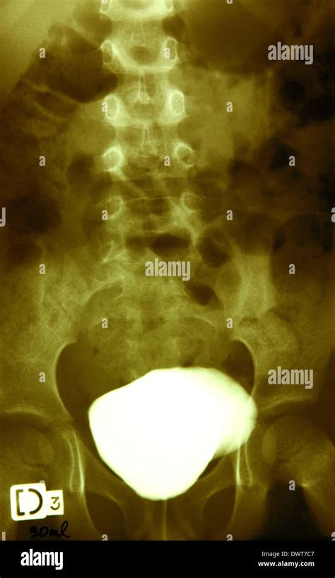 Retrograde cystography Stock Photo - Alamy