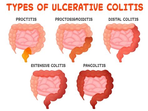 What is Ulcerative Colitis? | The IBS & Gut Health Clinic