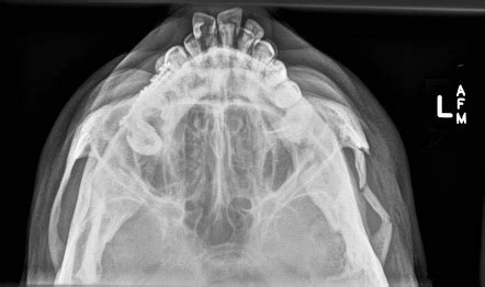 Zygomatic arch fractures | Radiology Reference Article | Radiopaedia.org