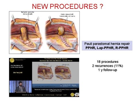 How to repair parastomal hernias Overview Y RENARD