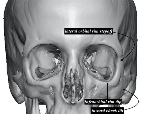 The Relationship Between Lower Eyelid Shape and The Underlying Infraorbital-Malar Bones ...