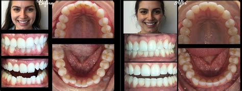 Platinum Invisalign Dentist in Stamford, CT | Affordable Invisalign Braces