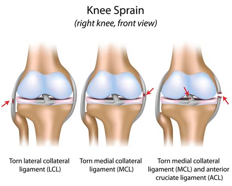 Knee Injury? Take Care of All Your Knee Ligaments | HuffPost