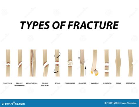 Types Of Bone Fractures Medical Educational Vector | CartoonDealer.com ...