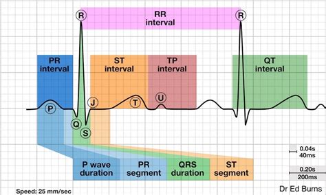 ECG: What about U waves? — Maimonides Emergency Medicine Residency