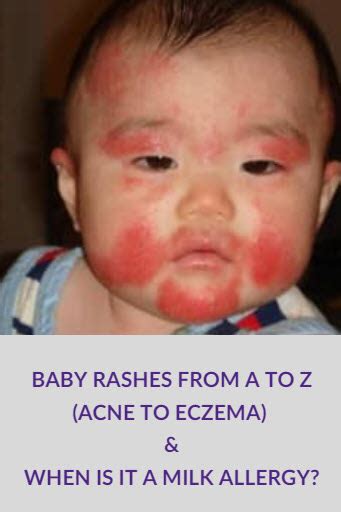 Common Baby Rashes (Acne to Eczema) | Is it a Milk Allergy Baby Rash?