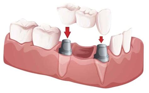 Porcelain Bridges - Birmingham Center For Cosmetic Dentistry